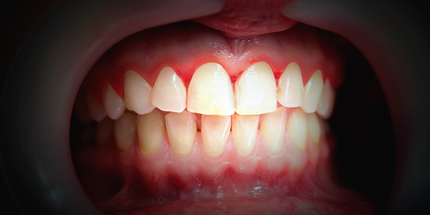 The Various Stages of Periodontal Disease