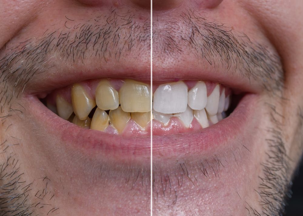 These 11 Health Problems Can Cause Yellow Teeth