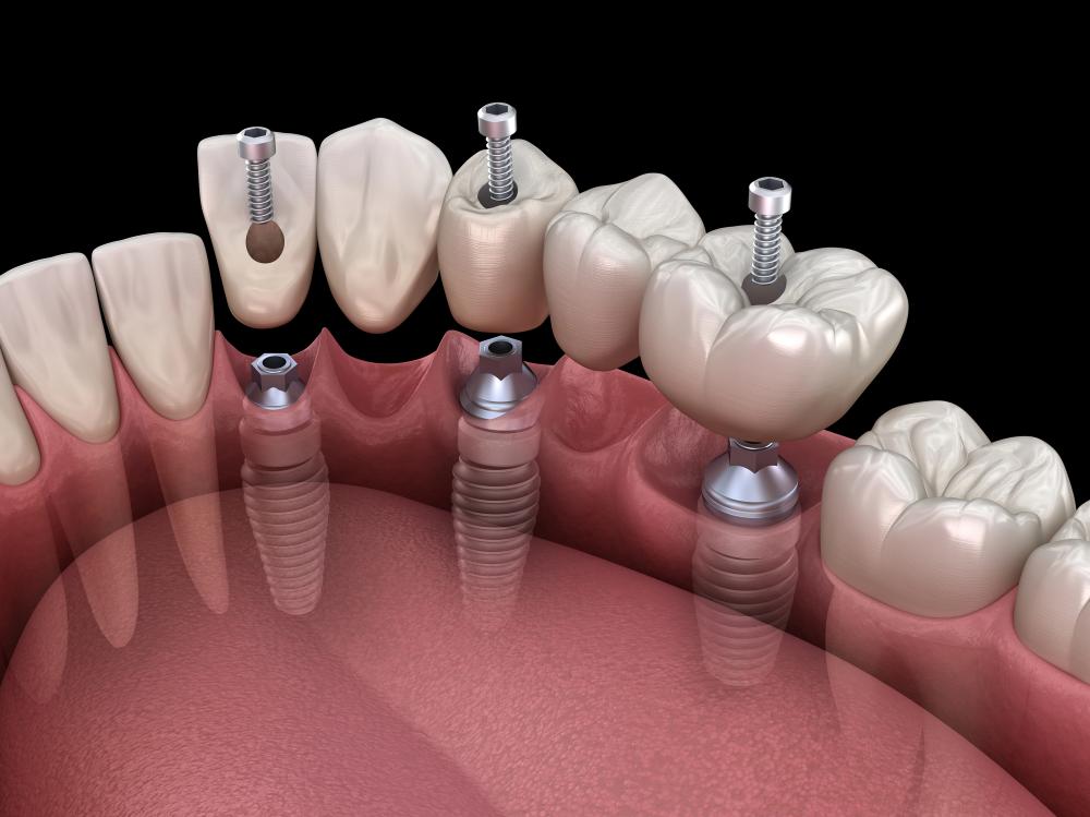 NYC dentist for full mouth reconstruction
