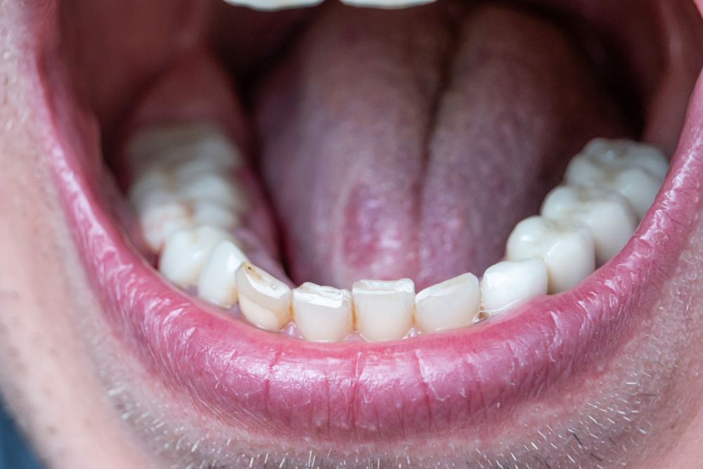 Tips To Take Care of Your Back Teeth