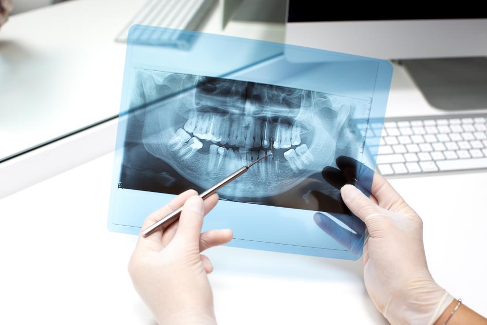 Top Benefits Of Digital X-Rays In Dental Care