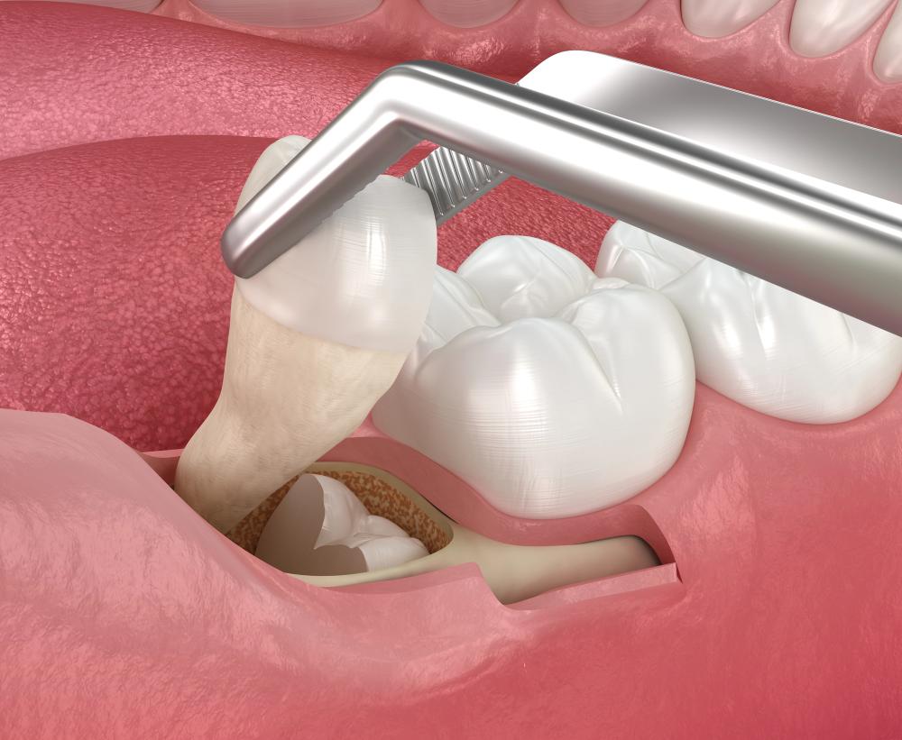 reasons for a tooth extraction