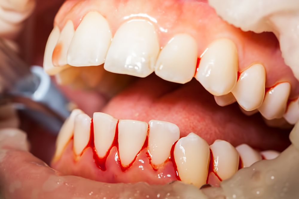 Top Reasons For Bleeding Gums