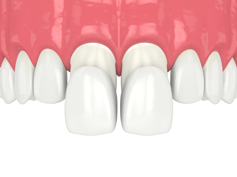 Traditional Vs. No-Prep Veneers: What’s The Difference?