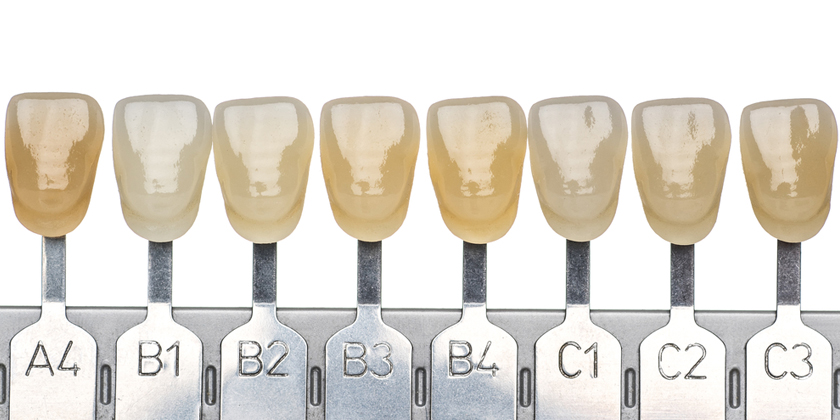Treating Worn Teeth Via Porcelain Veneers