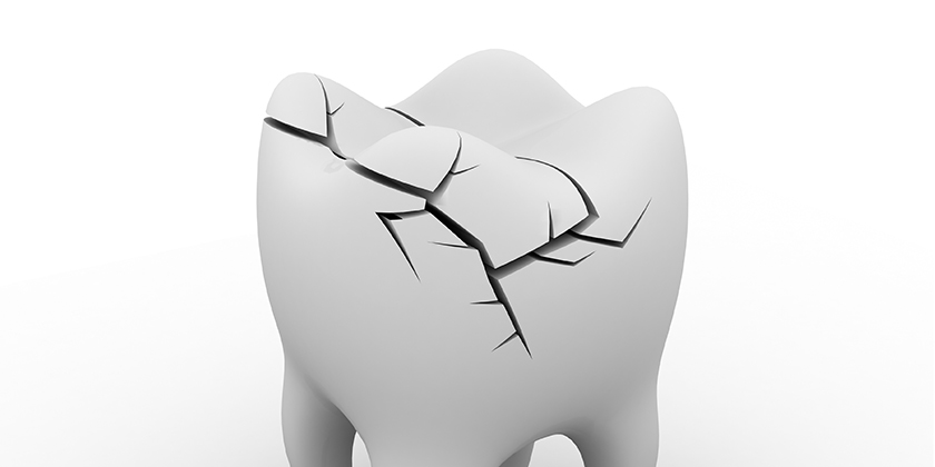 Cracked Tooth Syndrome