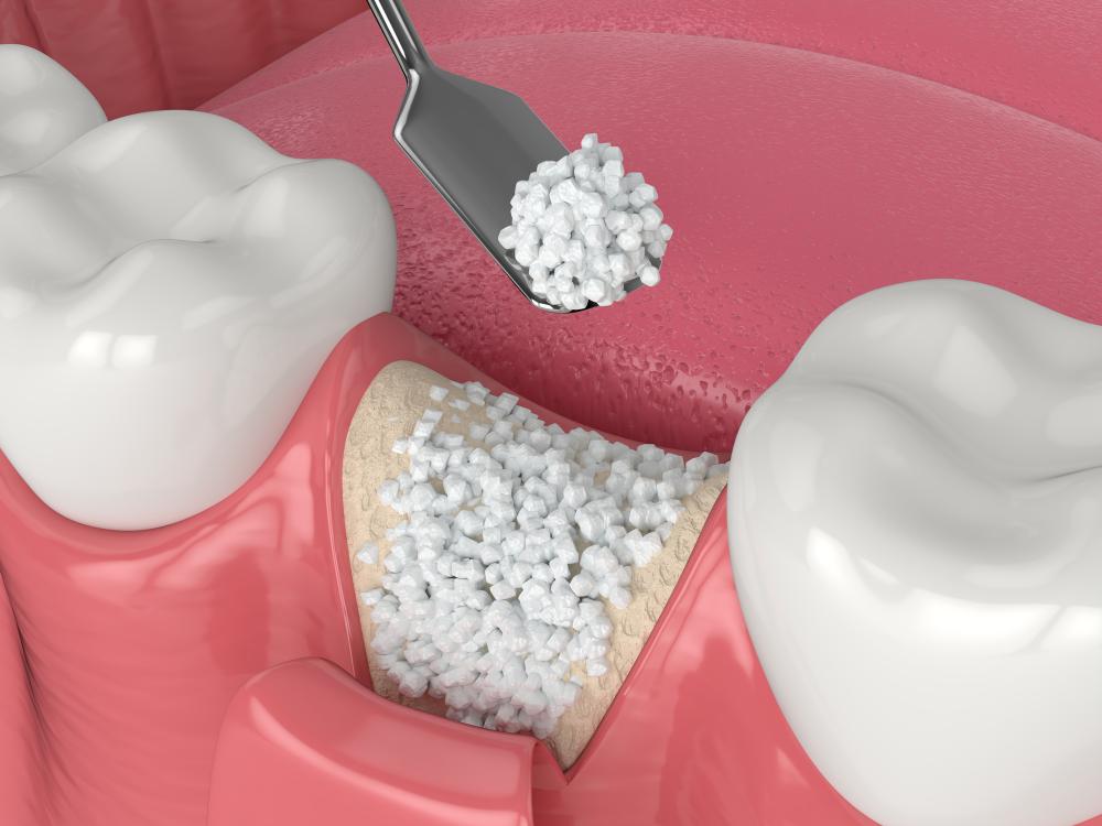 Understanding Dental Bone Grafts: A Patient’s Guide