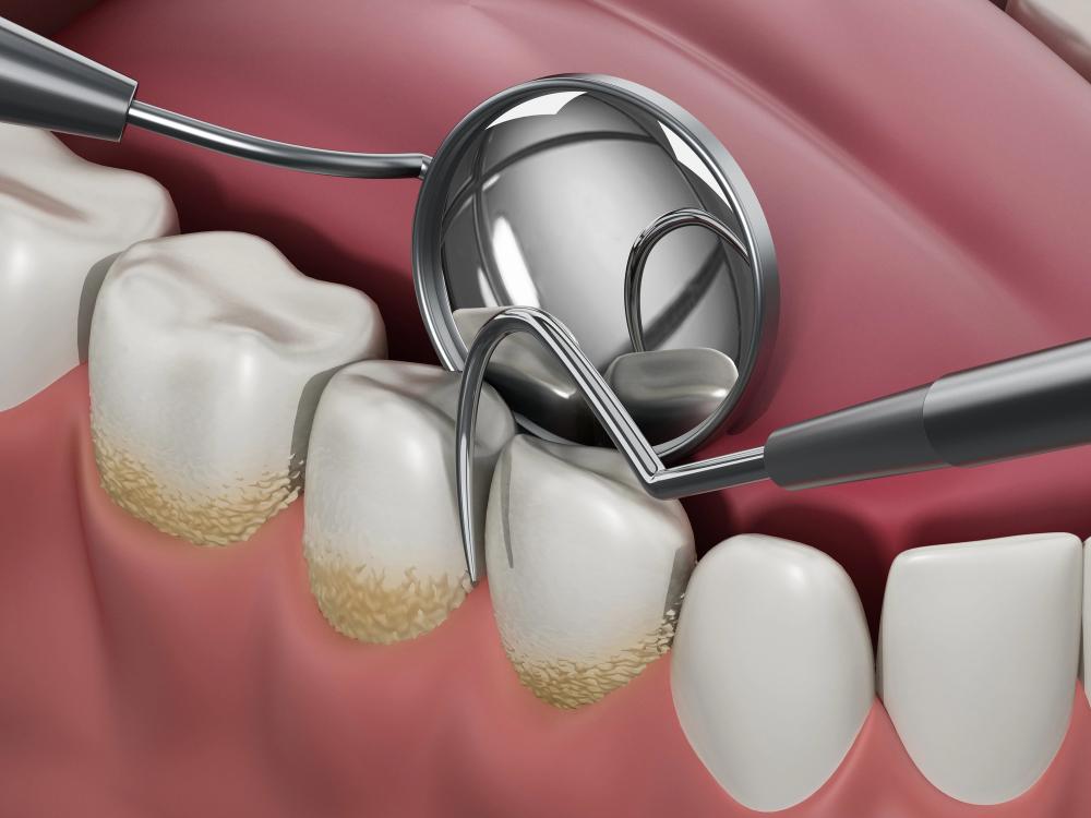 Understanding Dental Terms: Plaque Vs. Calculus And Their Impact