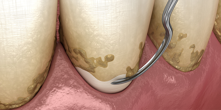 Understanding Periodontal Cleaning
