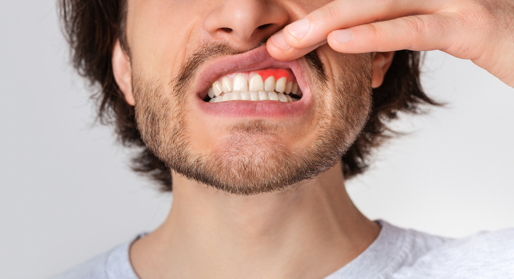 Understanding The Common Causes Of Bleeding Gums