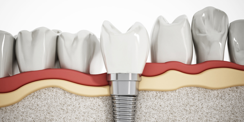 Understanding The Differences Between Mini And Standard Dental Implants