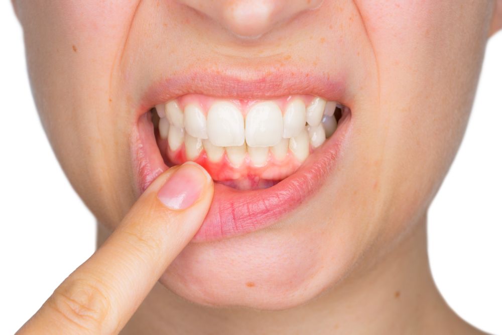 Understanding The Earliest Stage Of Periodontal Disease