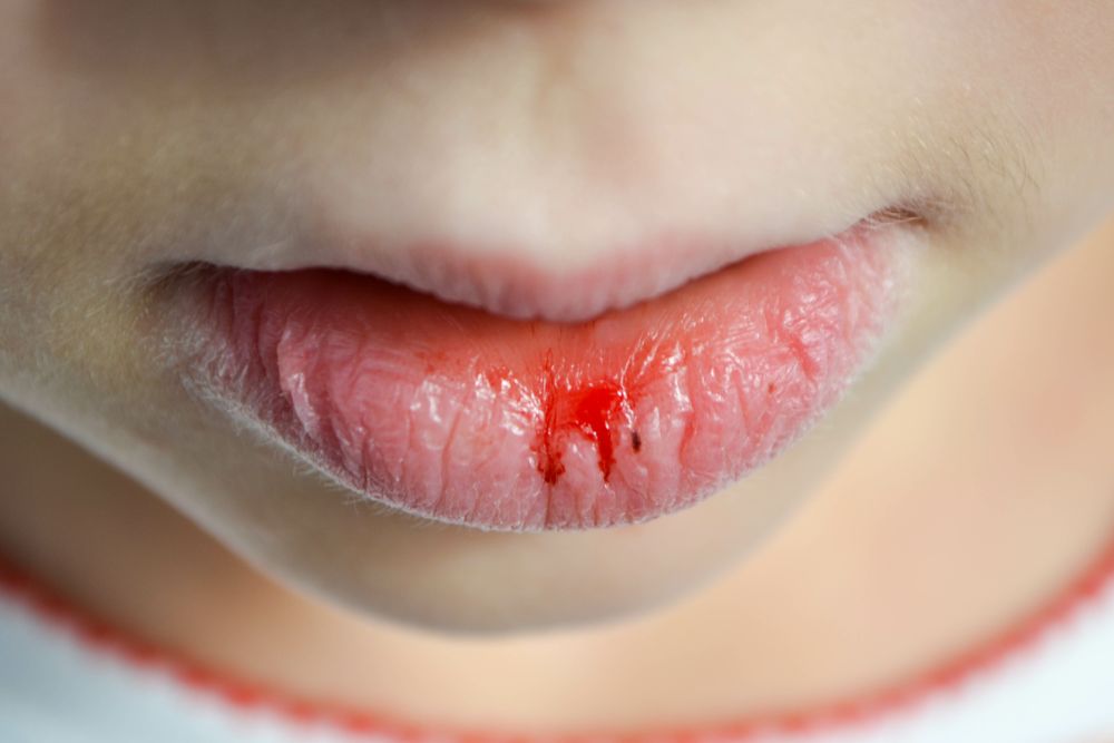 Understanding The Oral Effects Of Dry Mouth