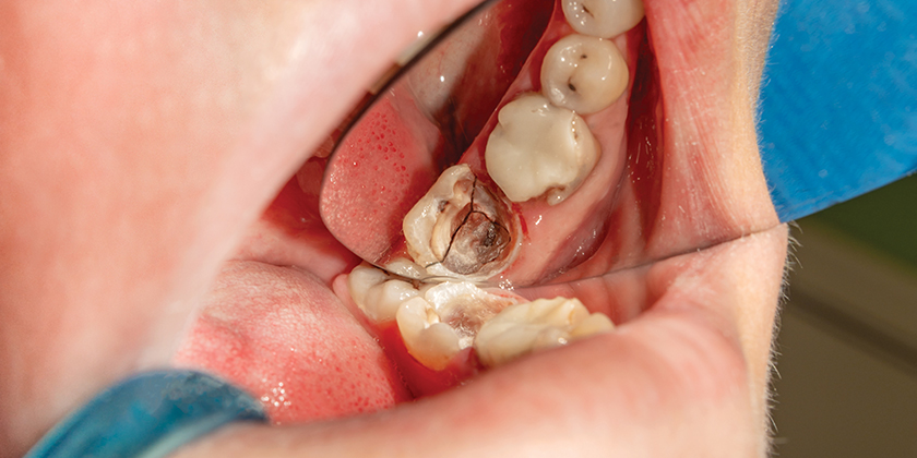 Understanding The Various Kinds Of Tooth Fracture