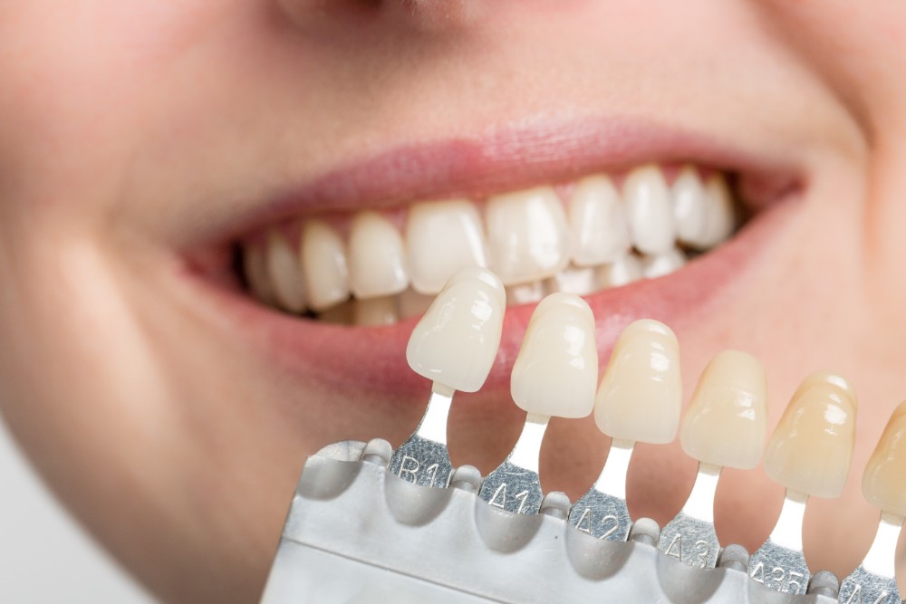 What Are The Differences Between Composite Resin Bonding & Veneers?
