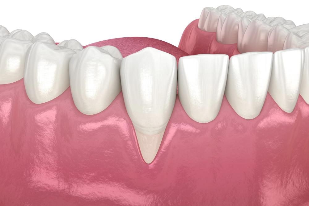 veneers and gum recession