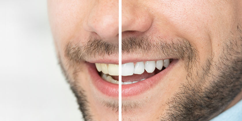Teeth Whitening: Ways You Can Whiten Your Teeth Without Damaging Them