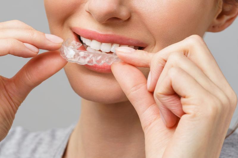 What Are Invisalign Refinements And Do You Need Them?