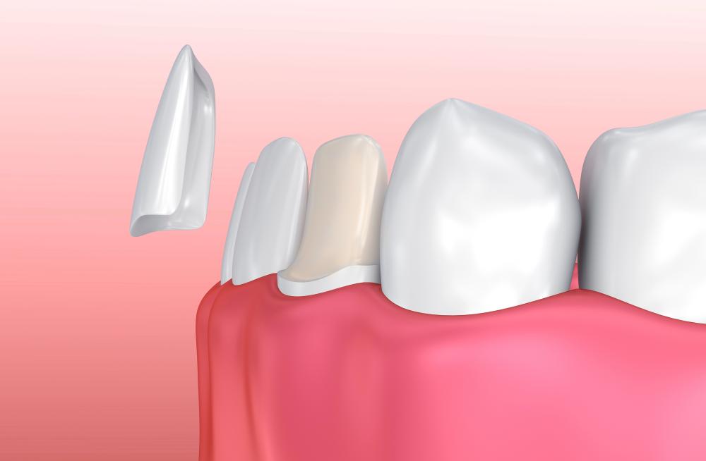 What Are No Prep Porcelain Veneers?