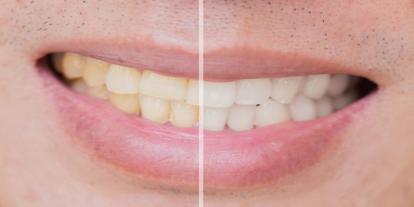 What Are The Different Types Of Tooth Staining?
