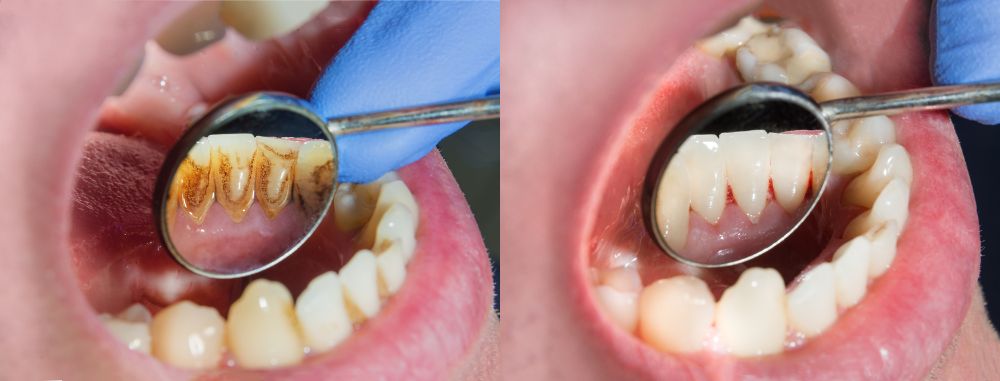 What Are The Long-Term Risks Of Periodontal Disease?