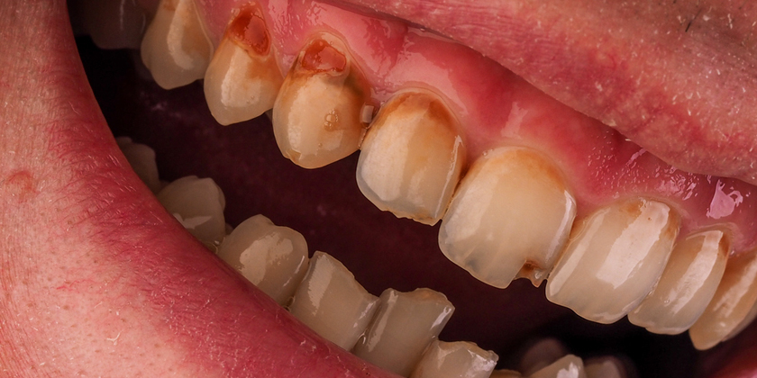 What Are The Major Signs Of Gum Disease?