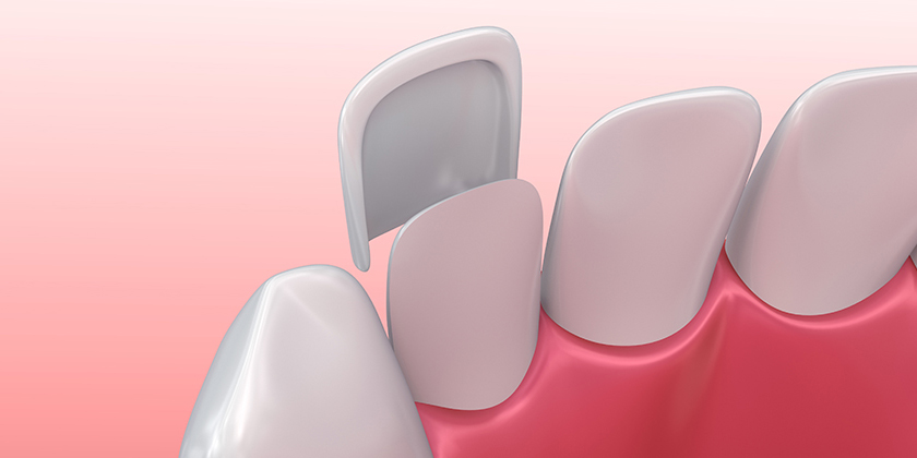 What Are The Most Common Questions About Porcelain Veneers?