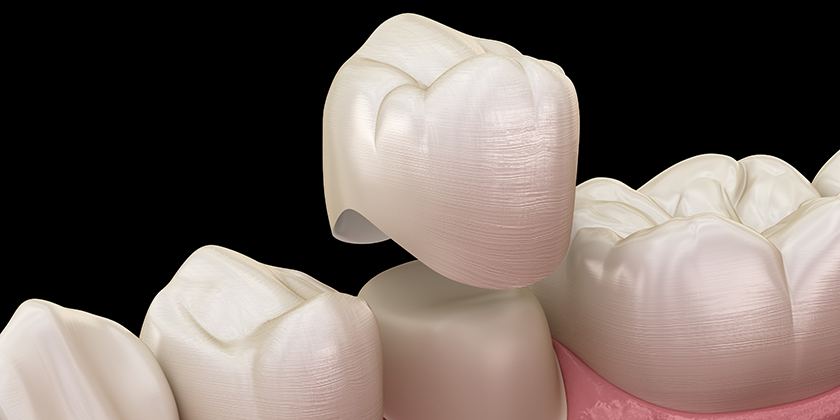 What Can A Dental Crown Do For You?