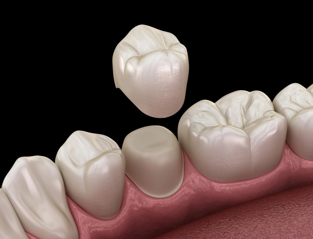 What Can You Eat After Getting A Dental Crown?