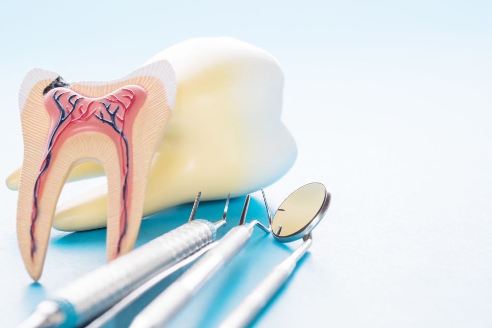 What Exactly Is A Root Canal?