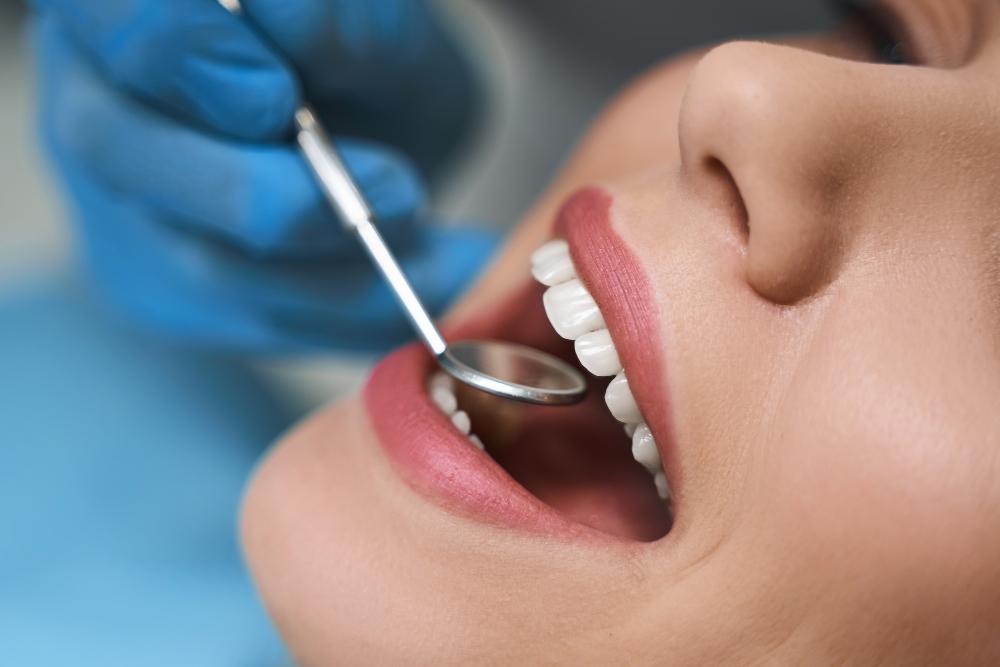 Teeth Under Veneers