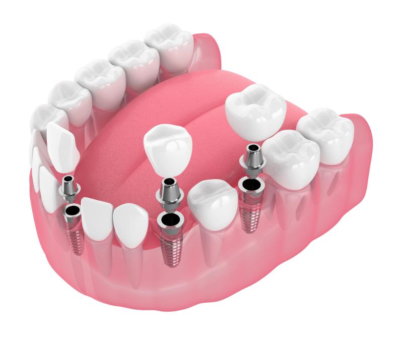 What Is An Implant-Supported Bridge And How Does It Work?
