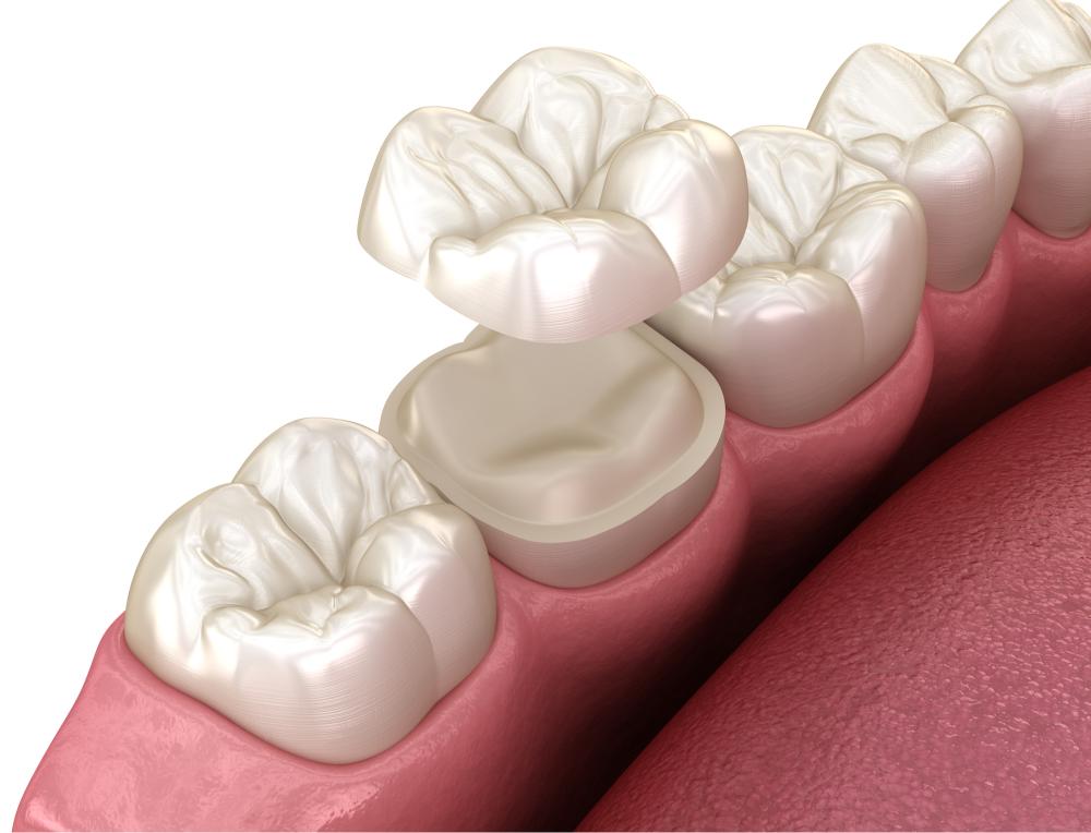 What Is An Onlay Restoration And When Do You Need It?