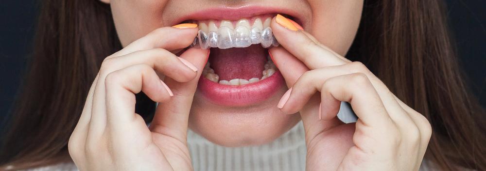 invisalign not tracking