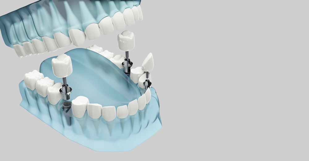 What To Ask Your Dentist About Implant-Supported Dentures