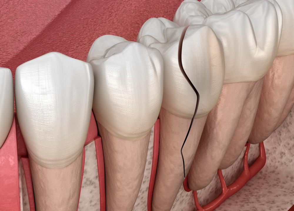What To Do For A Cracked Tooth: A Guide