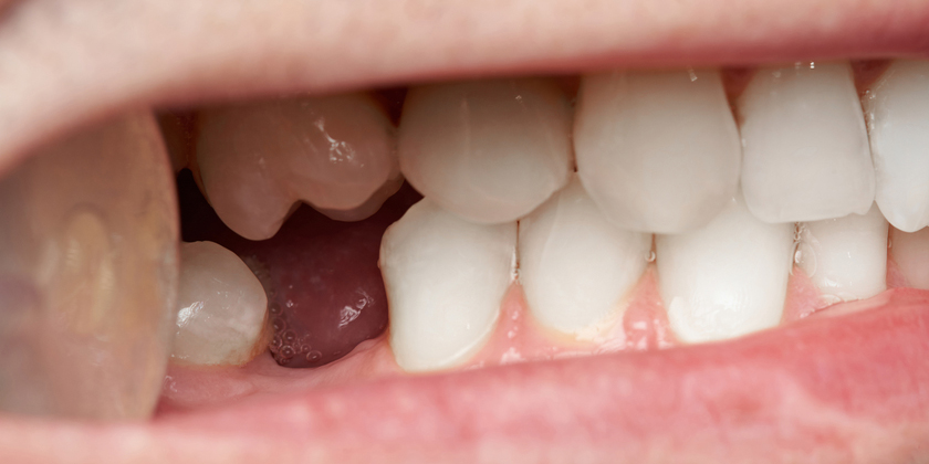 missing tooth