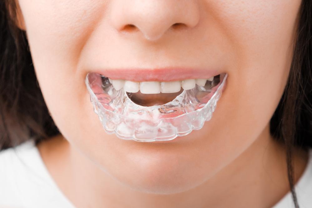 What To Do If Your Invisalign Attachment Fell Off