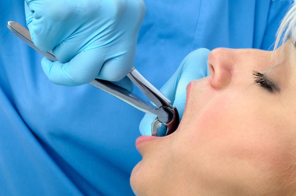 What To Eat After Tooth Extraction For A Pain-Free Recovery