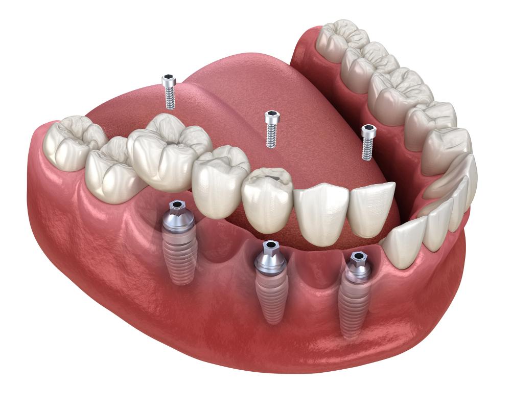 What You Need To Know About Dental Implants