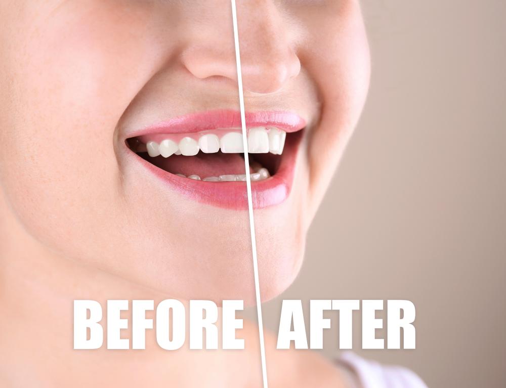 what is tooth contouring