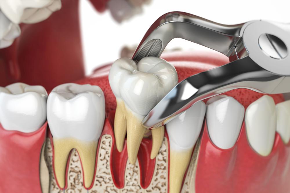 When Can You Eat Solid Foods After Wisdom Tooth Extraction?