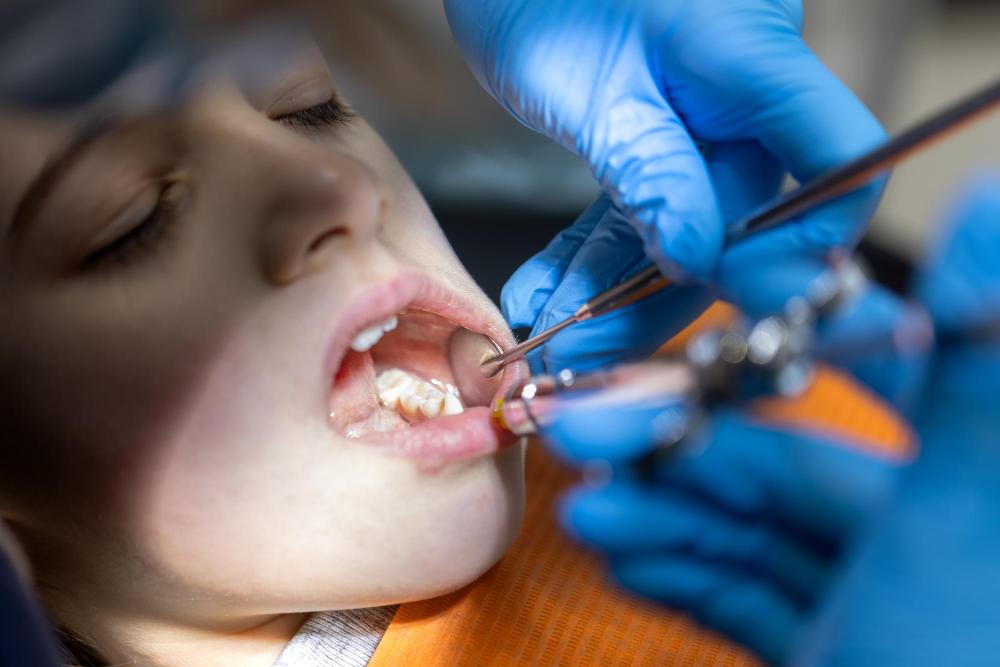 When Do Fillings Need To Be Replaced? 5 Signs It’s Time