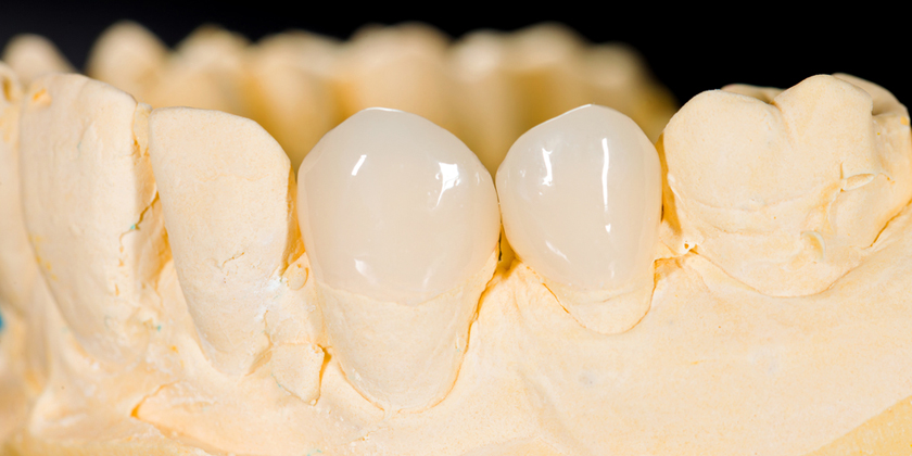 When Do You Need To Replace Your Porcelain Veneers?