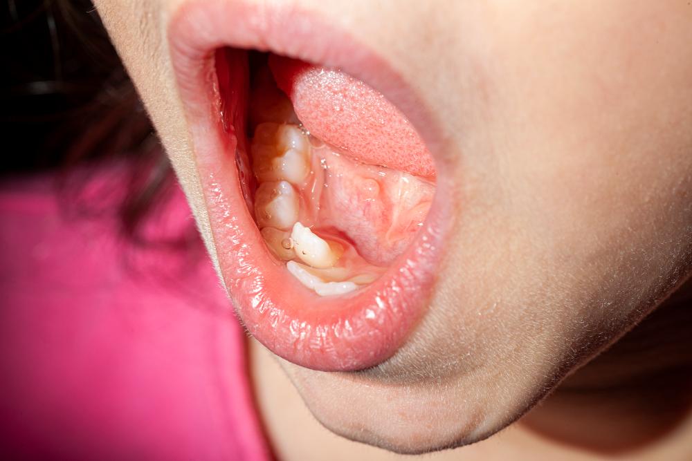 When Your Child Has Two Rows Of Teeth: Understanding And Solutions