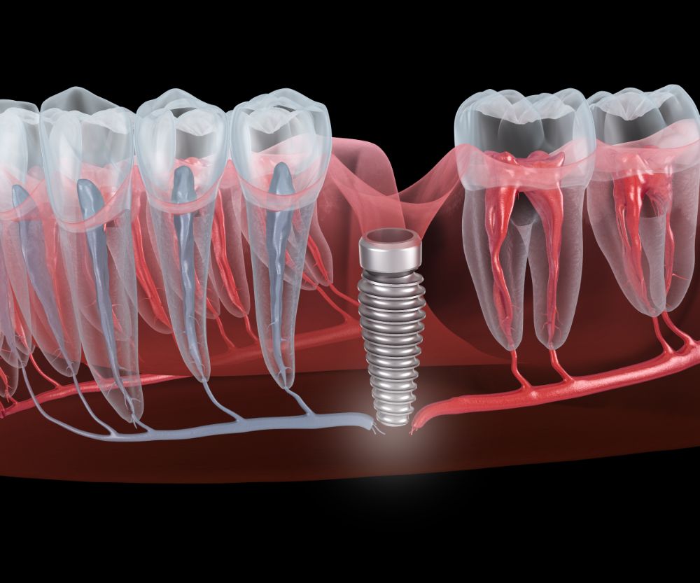 Who Is Responsible for Dental Implant Failure? Understanding The Causes First