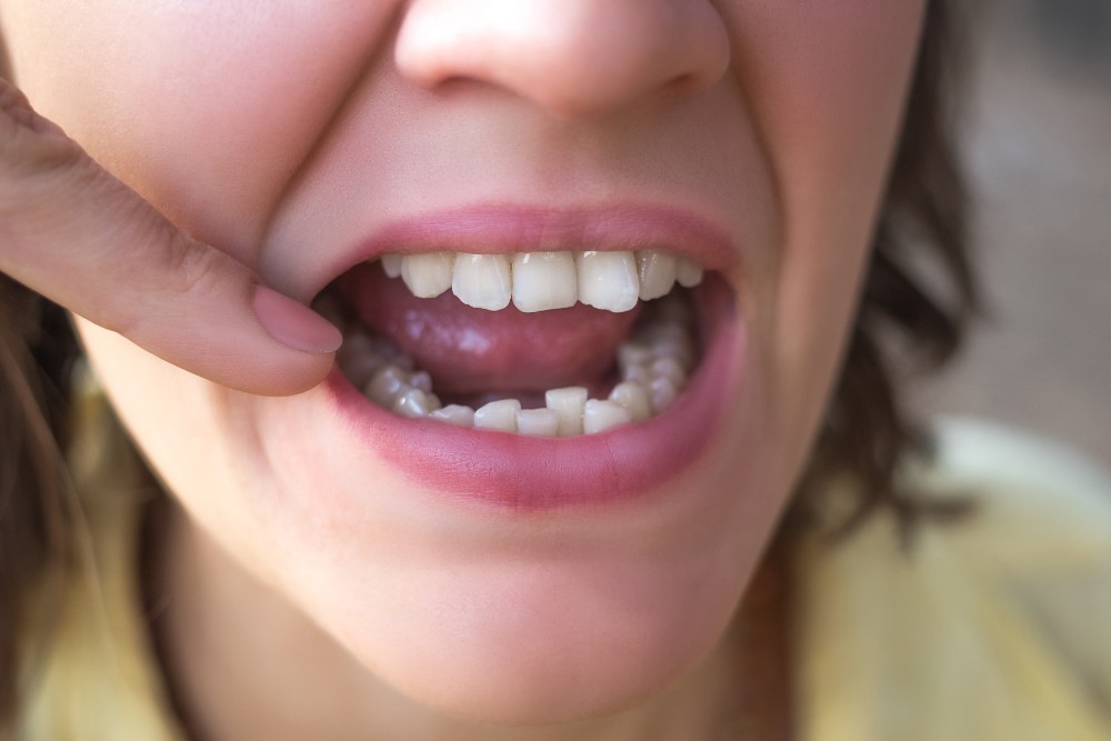 Don’t Underestimate The Havoc Crooked Teeth Can Wreck