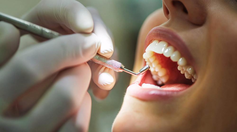 Why Dentists Suggest Dental Cleaning Every 3 Months
