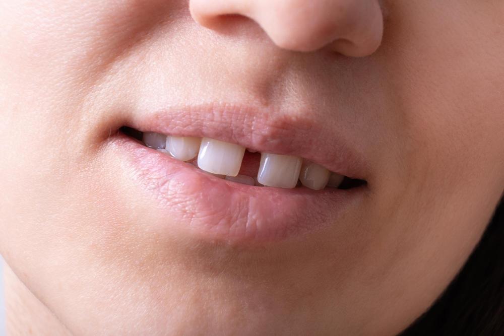 Why Do Some People Develop Gap Teeth? 5 Common Reasons