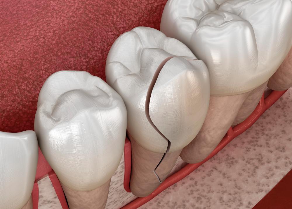 why do i have cracks in my teeth